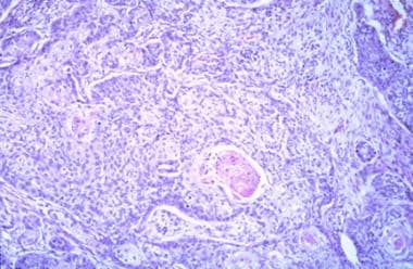 Histological specimen of squamous cell carcinoma (