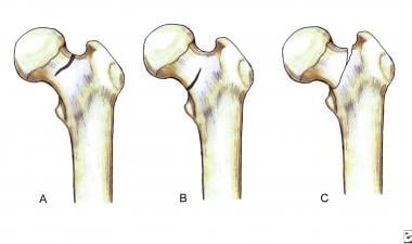 Classification of femoral neck stress fractures. 