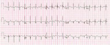 Electrocardiogram from a patient with a partial at