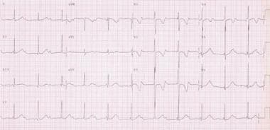 This is a 12-lead electrocardiograph (ECG) of a 2-