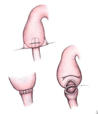 Pediatric duodenal atresia. Diamond-shaped duodeno