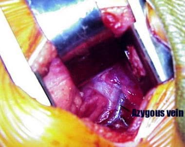 Intraoperative photograph showing azygos vein. Rig