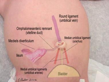 Omphalitis: Background, Pathophysiology, Etiology