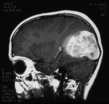 MRI显示幕上多发性胶质母细胞瘤