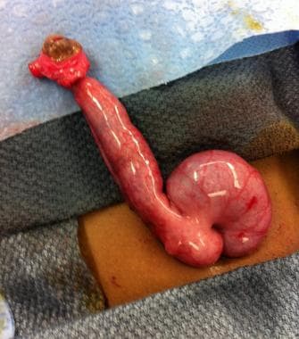 Intestinal obstruction in the newborn. Omphalomese