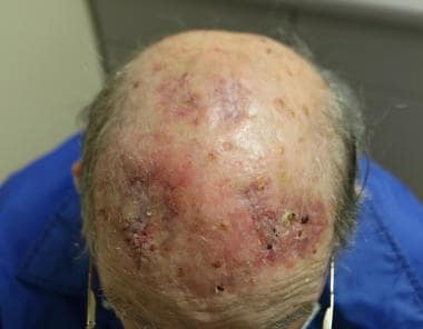Erosive pustulosis of the scalp 4 weeks following 