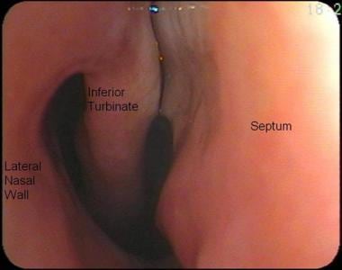 View of the anterior portion of right nasal cavity