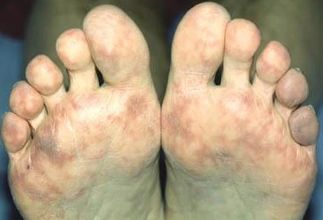 Pes Saudaveis Veja 12 Problemas Que Afetam A Regiao E Como Preveni Los 13 08 2020 Uol Vivabem