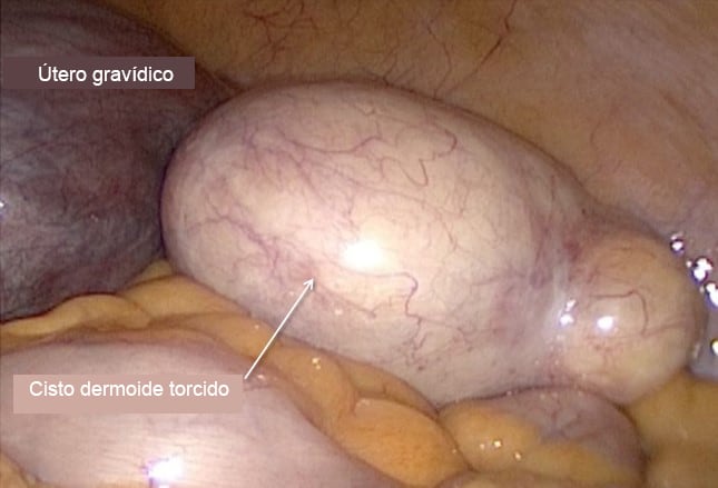 Ooforectomia laparoscópica para massa ovariana sólida