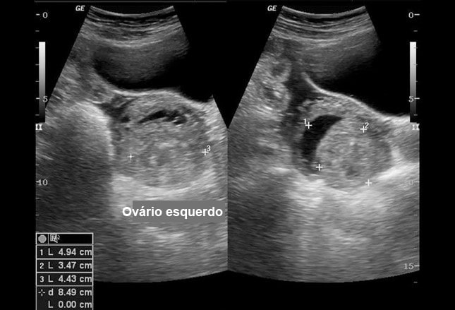 PDF) ABORDAGEM MINIMAMENTE INVASIVA COMBINADA: RESSECÇÃO DE CISTO  MESENTÉRICO GIGANTE E CISTO OVARIANO E OOFOROPLASTIA À ESQUERDA COM  RESSECÇÃO DE TUMOR DE OVÁRIO À DIREITA POR MINILAPAROSCOPIA: 2 RELATOS DE  CASO