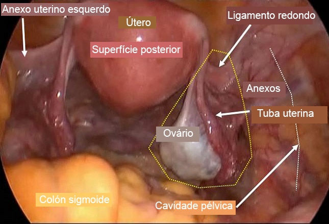 Ooforectomia laparoscópica para massa ovariana sólida