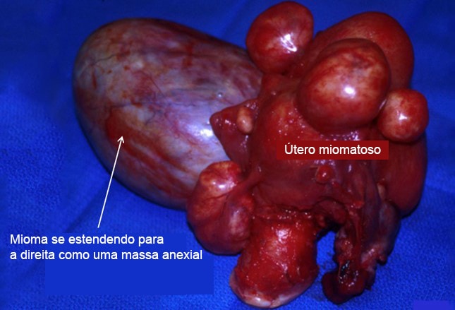 Cistos ovarianos e outras massas ovarianas benignas - Problemas de