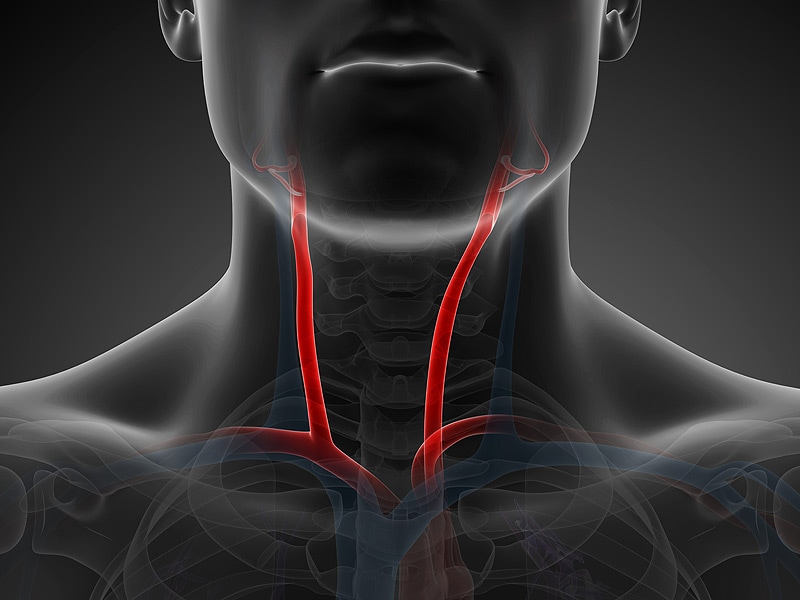 Crest Baixas Taxas De Ave Apos 10 Anos Com Stent Ou Cirurgia Carotidea