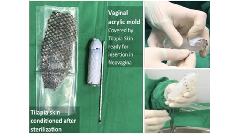 Como a pele de tilápia é usada para vaginoplastia e redesignação sexual