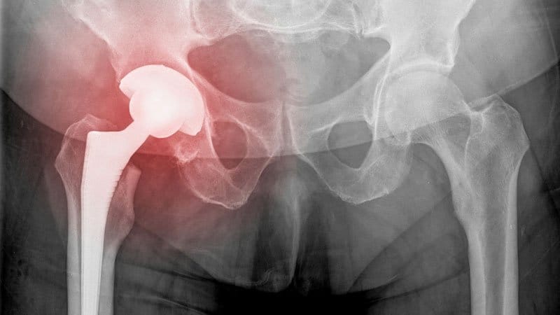 Denosumabe pode reduzir a necessidade de cirurgia de revisão do quadril