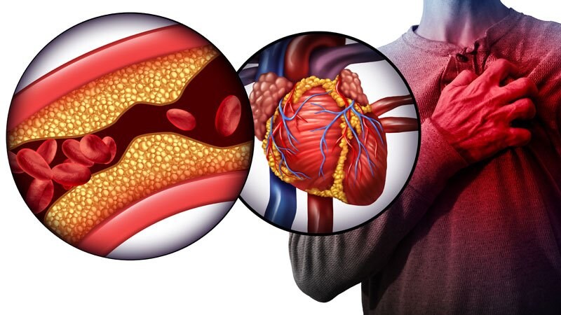 Infarto agudo do miocárdio: conheça os cinco sinais de alerta