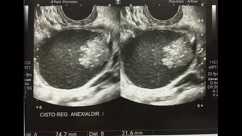 Ooforectomia x Ooforoplastia - Cirurgia no ovário 