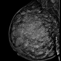 Mulher de 37 anos com vários fibroadenomas