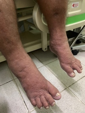 Caso Clínico: Artralgia, síndrome edematosa e dispneia progressiva em homem  de 69 anos