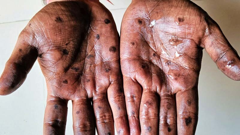 Teste R pido Diagn stico Diferencial Da Mpox