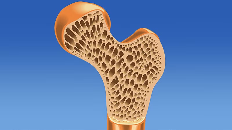 O Que é Baixa Densidade Mineral óssea