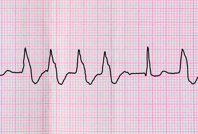 Como avaliar e tratar pacientes com extrassístoles ventriculares