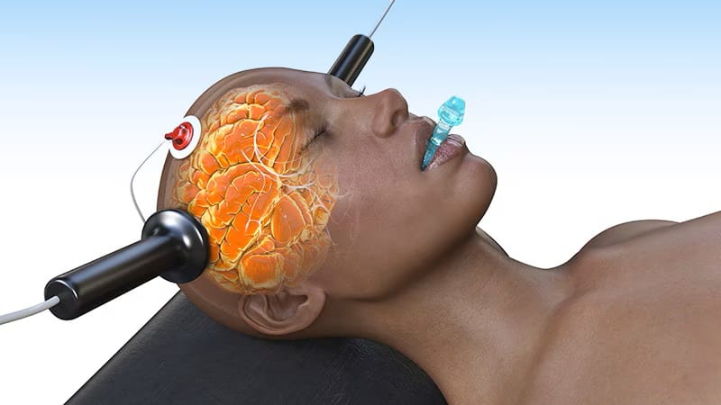 Como a eletroconvulsoterapia funciona? Cientistas podem ter encontrado ...