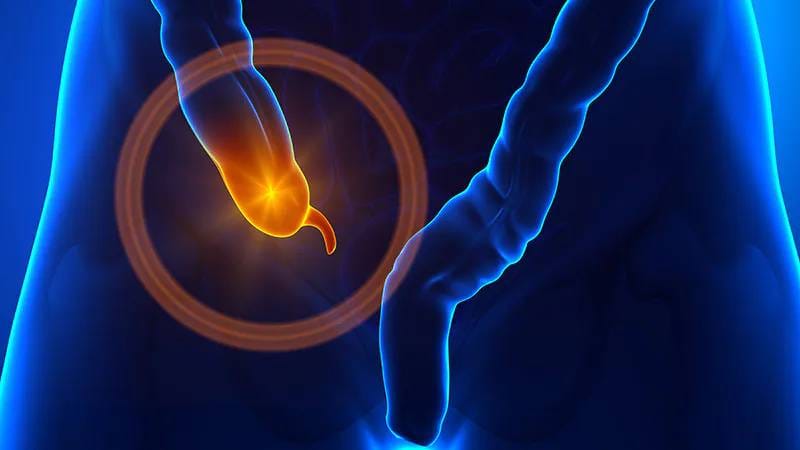 Antibioticoterapia na apendicite aguda: boa opção para alguns pacientes