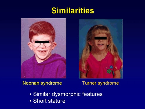 To Treat or Not to Treat: Short Stature in Noonan Syndrome (Transcript)