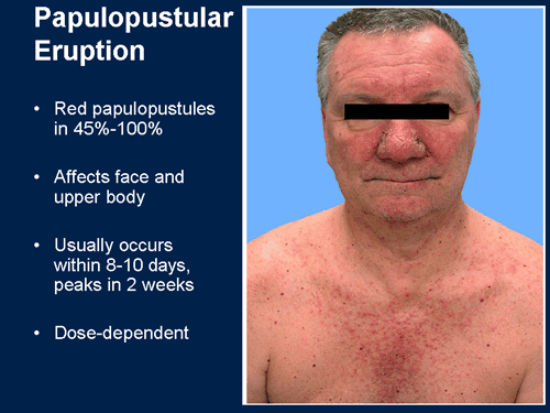 Egfr Associated Rash Management of Dermatologic and Other Toxicities Associated With EGFR ...