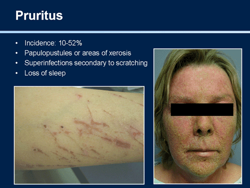 Egfr Rash Face Management of Dermatologic and Other Toxicities Associated With EGFR ...