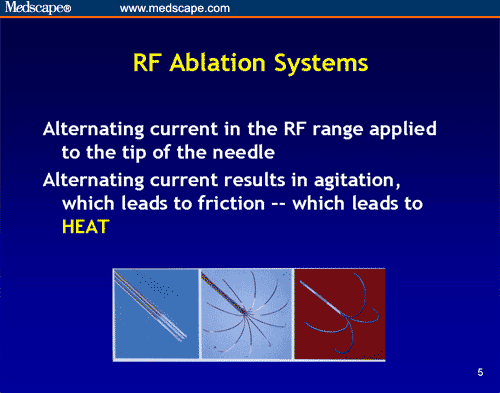 Managing Liver Lesions: Role of Adjunctive Radiofrequency Ablation ...