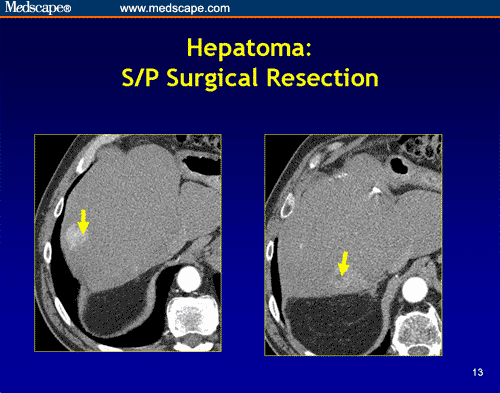 Managing Liver Lesions: Role of Adjunctive Radiofrequency Ablation ...