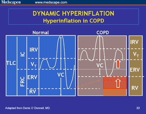 COPD: An Update on Diagnosis and Treatment (Archived Web 