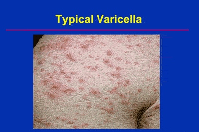 Varicella Immunization: Current Status and Practice