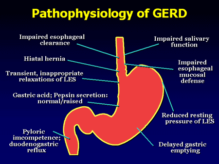 Not All Heartburn Patients Are Equal: Strategies for Coping With...