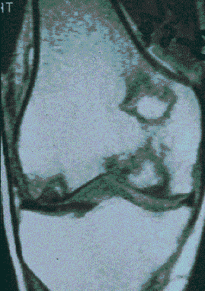Opposing Views in the Treatment of OA of the Knee