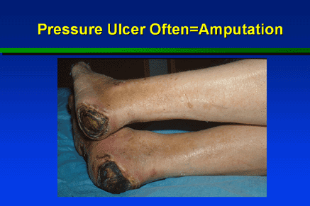 Challenges caused by pressure ulcers in the article pressure ulcer intervention
