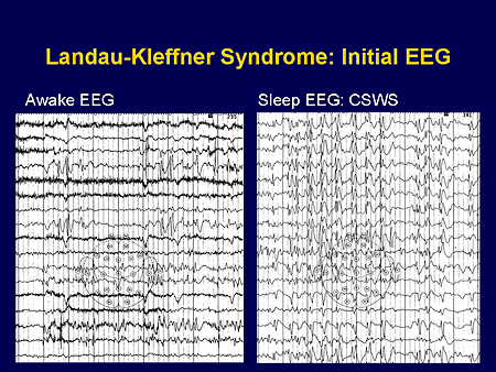Landau-Kleffner Syndrome: Initial EEG