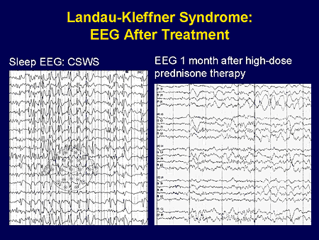 Landau-Kleffner Syndrome: EEG After Treatment
