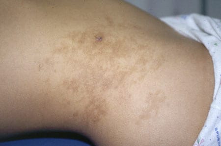 Masters of Pediatrics: Dermatology