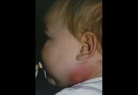 Summertime Infections - Kids Plus Pediatrics