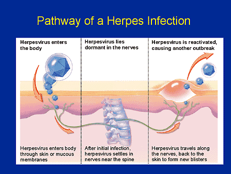 herpes law in texas