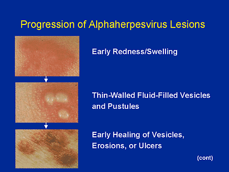 Progression of Alphaherpesvirus Lesions