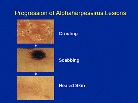Progression of Alphaherpesvirus Lesions