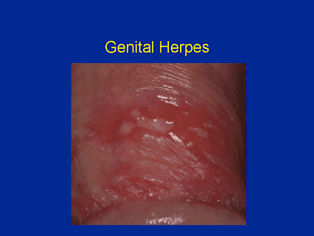 Genitalherpes penis