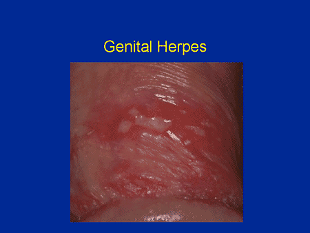 Herpes bilder genital Herpes Photos: