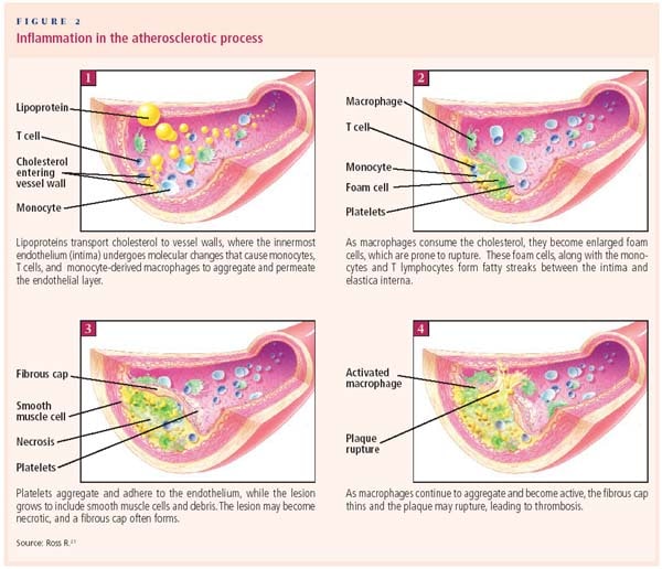 atherosclerosis process