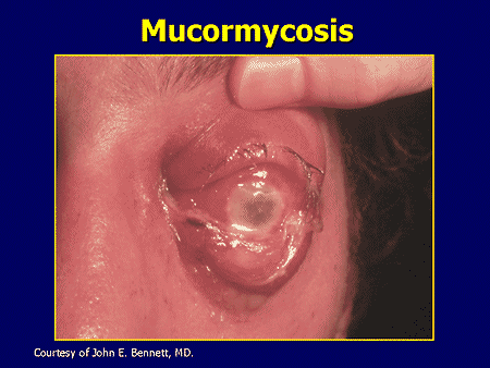 Management of Fungal Infections in the High-Risk Patient