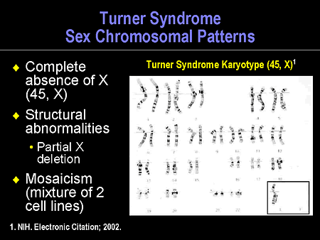 turner syndrome chromosome